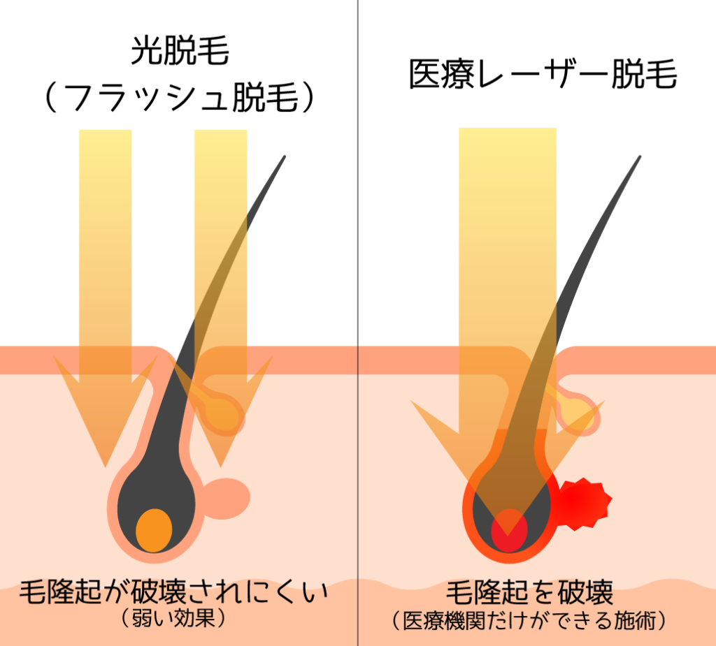 医療レーザー脱毛 ｜ 五福ひがし皮ふ科